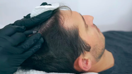 scalp micropigmentation